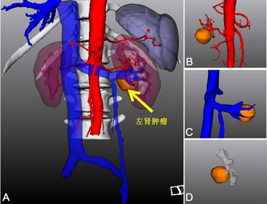 利用3D打印帮助医生成功实施肾脏肿瘤切除术.jpg